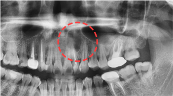 01. 치근단낭 periapical cyst