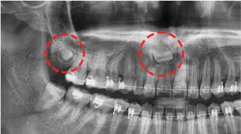03. 과잉치 supernumerary tooth