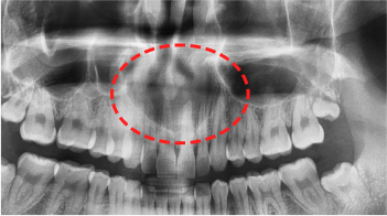 05. 비구개관낭 nasopalatine duct cyst