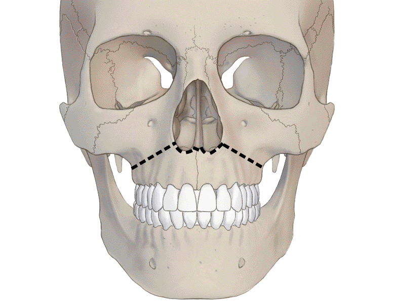 르포트 1 절골술 (Le Fort I osteotomy)
