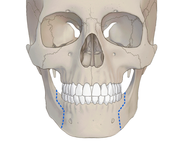 시상골 절단술 (SSRO, Sagittal Split Ramus Osteotomy)