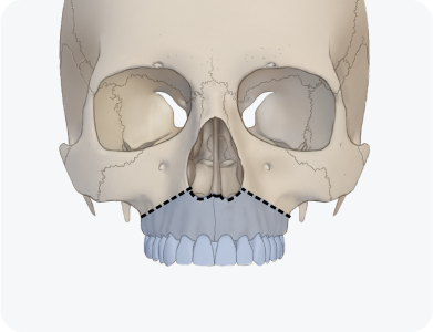 르포트 1형 골절단술 (Le Fort I osteotomy)