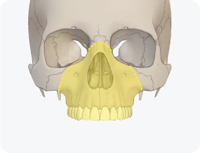 르포트 2형 골절단술 (Le Fort II osteotomy)