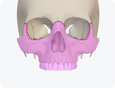 르포트 3형 골절단술 (Le Fort III osteotomy)