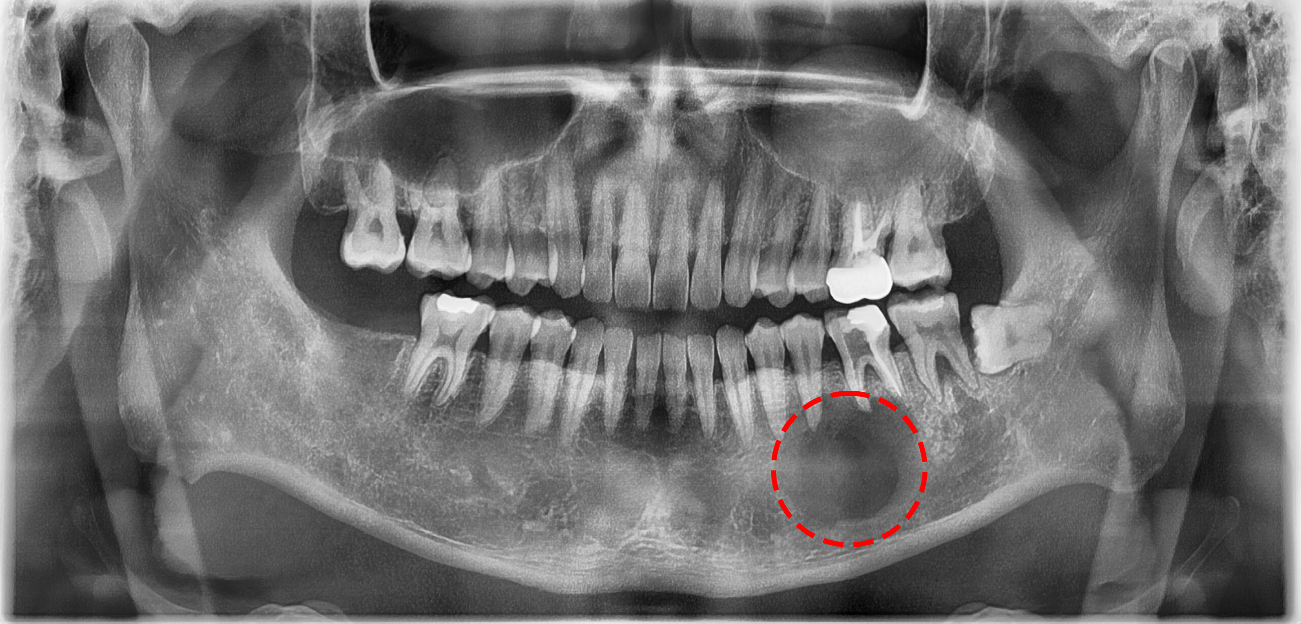 04. 각화성치성종양, 치성각화낭 (Keratocystic Odontogenic Tumor)
