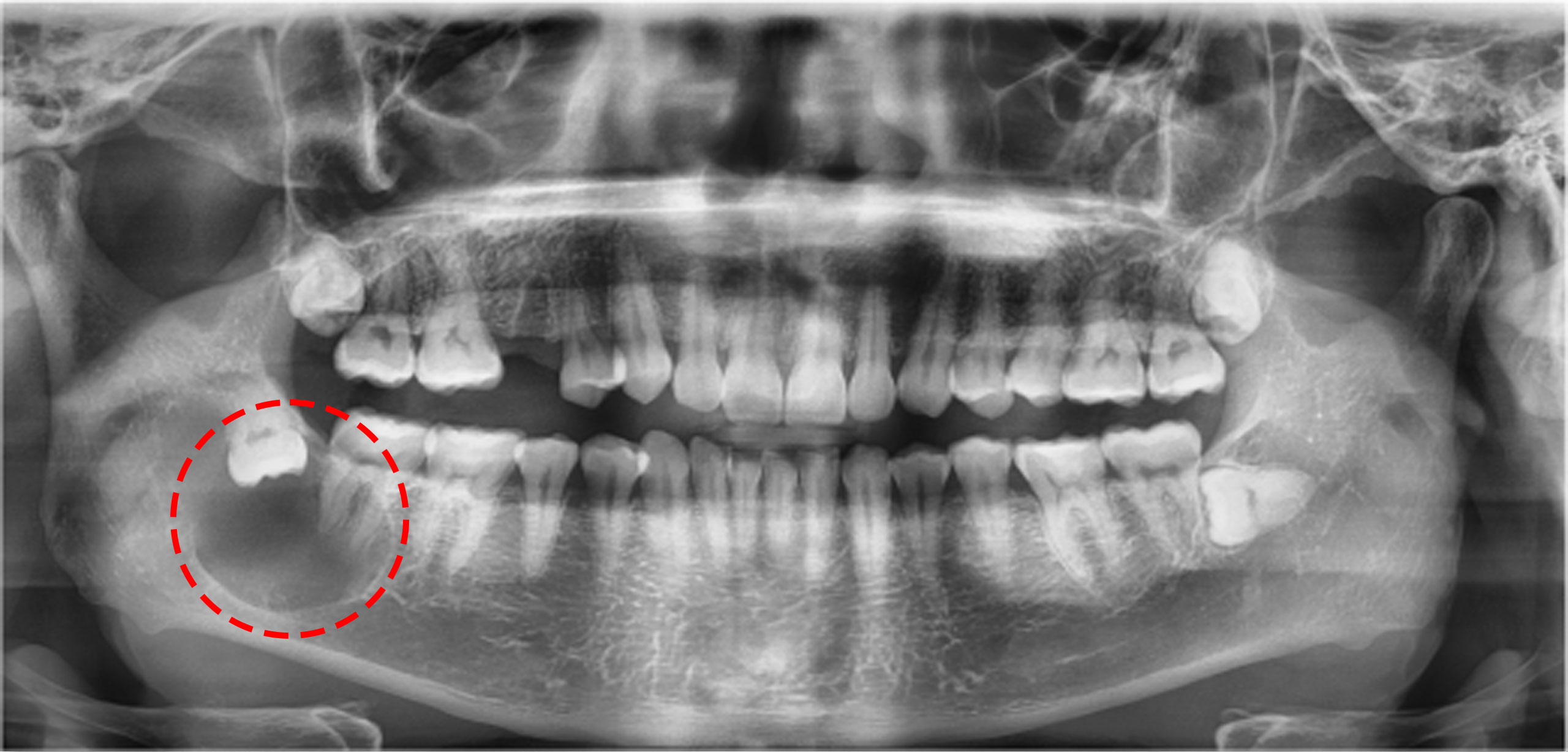 02. 함치성낭 dentigerous cyst