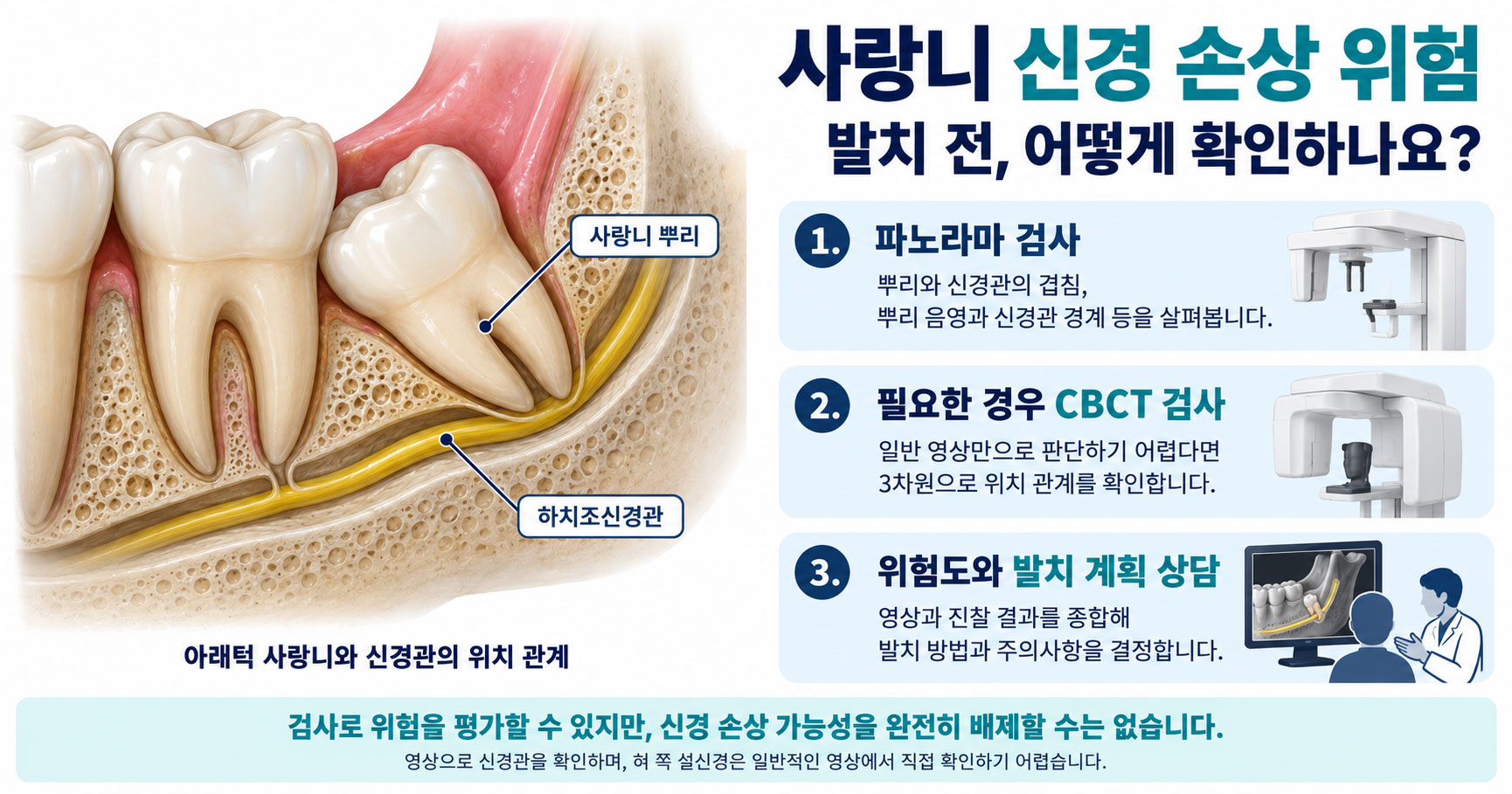 사랑니 신경 손상 위험을 판단하는 아래턱 사랑니 뿌리와 하치조신경관의 위치 관계 설명