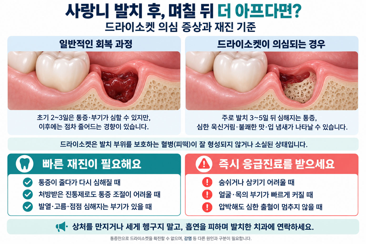 사랑니 발치 후 통증 원인인 드라이소켓 혈병 소실과 치조골 노출 상태 설명